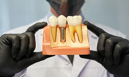 Implant